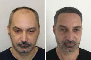 Résultat photos avant après greffe de cheveux – Budapest, Hongrie